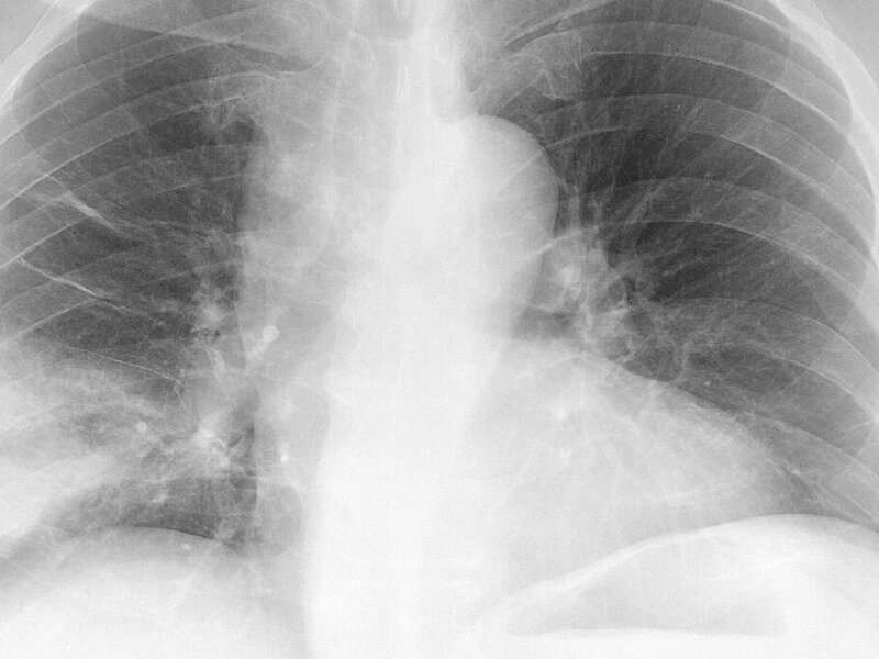 Plevral Fibrozis: Akciğerlerimizi Sıkıştıran Gizli Tehlike