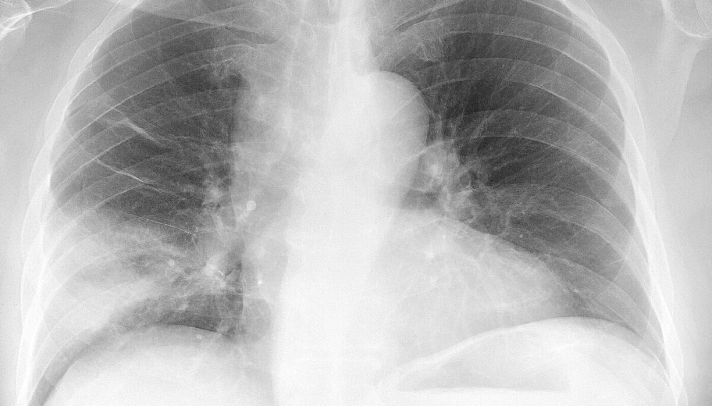Plevral Fibrozis: Akciğerlerimizi Sıkıştıran Gizli Tehlike